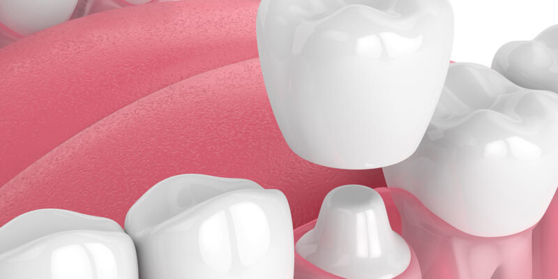 dental crown visual at peter family & cosmetic dentistry