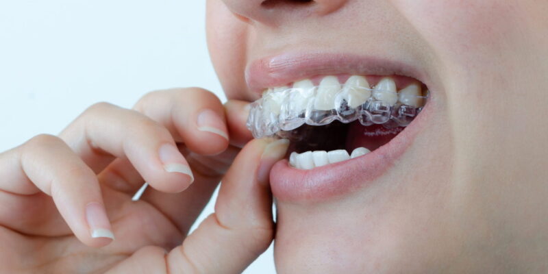 learn about the benefits of invisalign for busy adults with info from Peter Family Dentistry in Independence KY